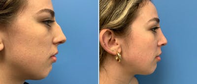 Rhinoplasty Before & After Gallery - Patient 181057869 - Image 1