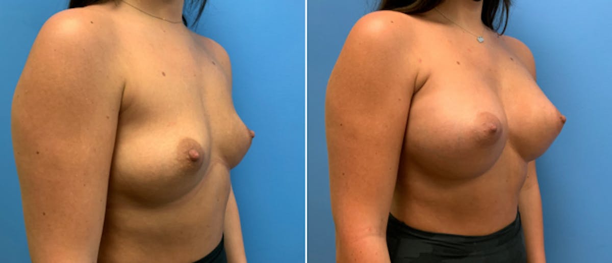 Breast Augmentation Before & After Gallery - Patient 181057883 - Image 1