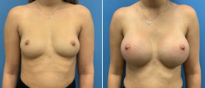 Breast Augmentation Before & After Gallery - Patient 181057884 - Image 1