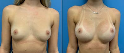 Breast Augmentation Before & After Gallery - Patient 181057885 - Image 1