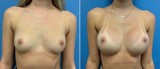Breast Augmentation Before & After Gallery - Patient 181057885 - Image 1