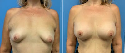 Breast Augmentation Before & After Gallery - Patient 181057886 - Image 1