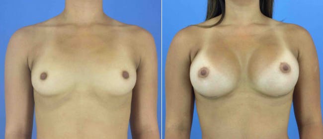 Breast Augmentation Before & After Gallery - Patient 181057887 - Image 1