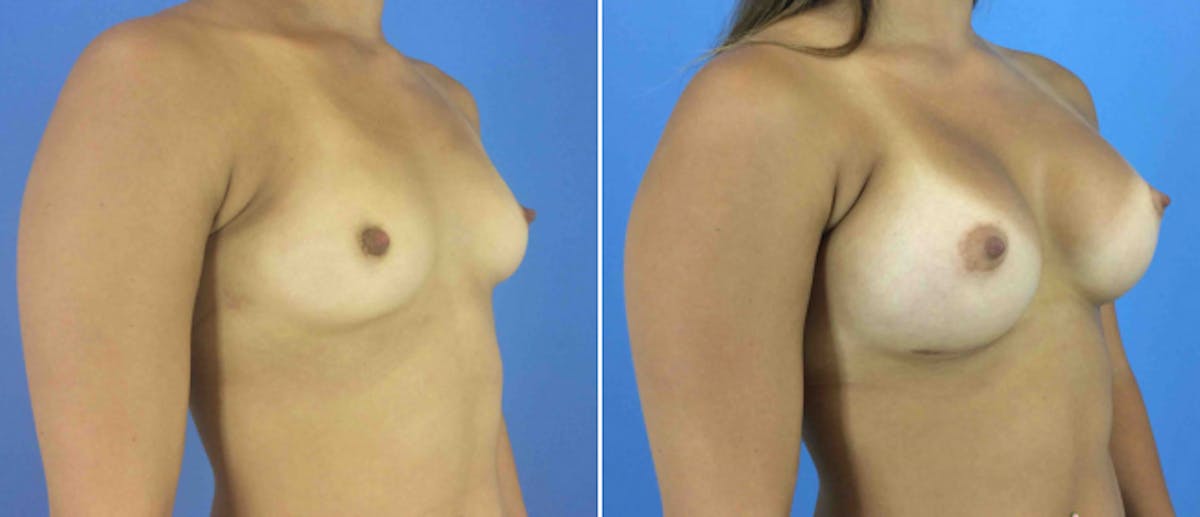 Breast Augmentation Before & After Gallery - Patient 181057887 - Image 2