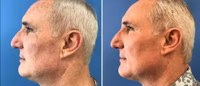 Laser Skin Rejuvenation Before and After