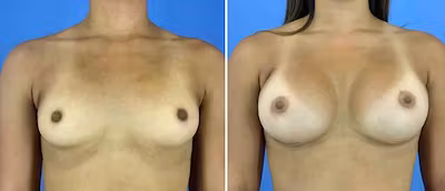 Before and After