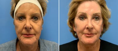Laser Skin Rejuvenation Before & After Gallery - Patient 382074 - Image 1