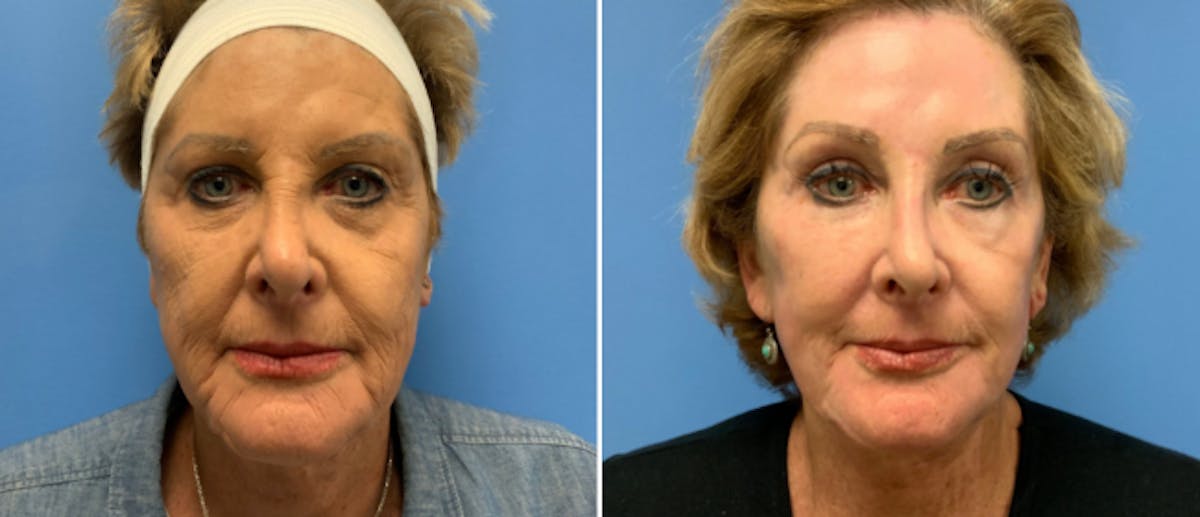 Laser Skin Rejuvenation Before & After Gallery - Patient 382074 - Image 1