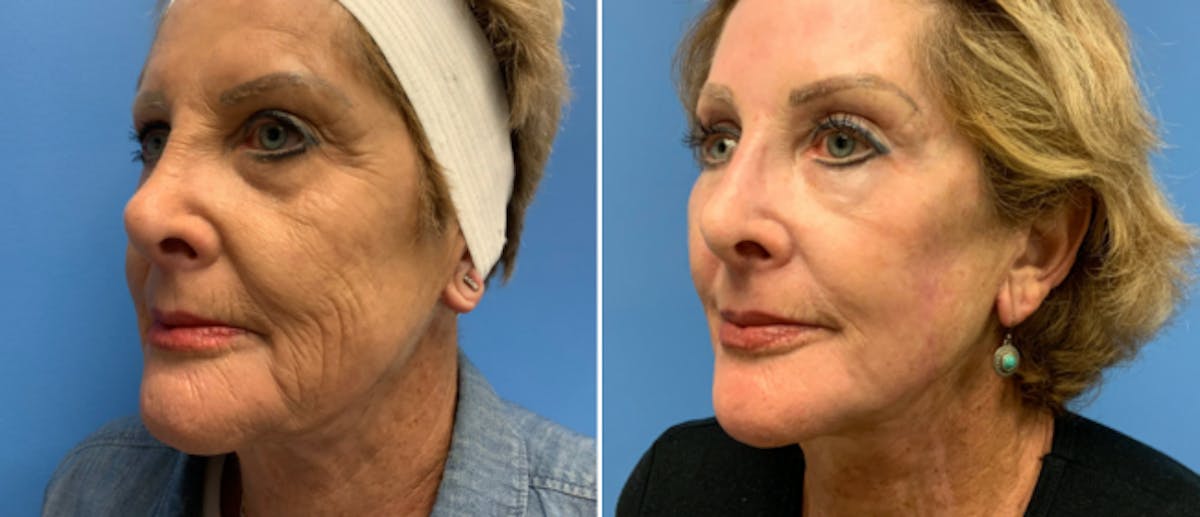 Laser Skin Rejuvenation Before & After Gallery - Patient 382074 - Image 2