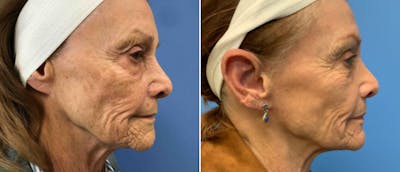 Laser Skin Rejuvenation Before & After Gallery - Patient 203632 - Image 1