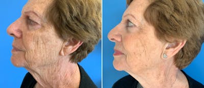 Laser Skin Rejuvenation Before & After Gallery - Patient 942963 - Image 1