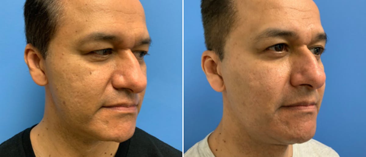 Micro-Needling Before & After Gallery - Patient 268480 - Image 1