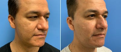 Micro-Needling Before & After Gallery - Patient 268480 - Image 1