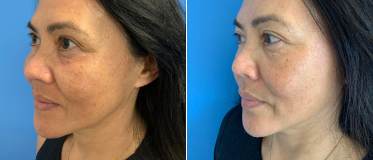 Micro-Needling Before & After Gallery - Patient 391466 - Image 1