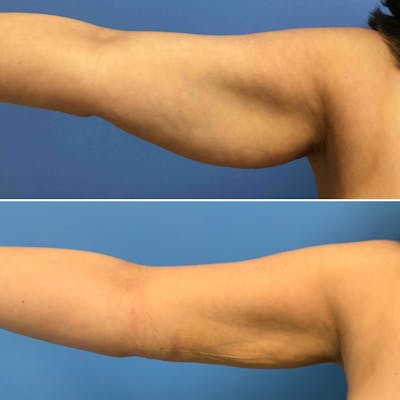 Liposuction Before & After Gallery - Patient 913873 - Image 1