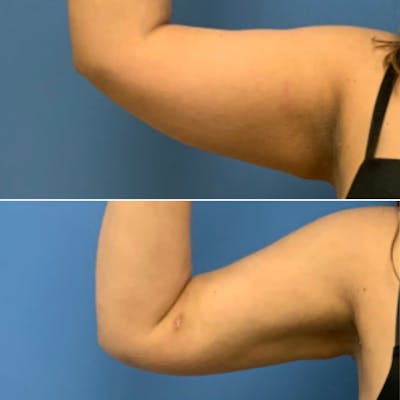 Liposuction / Bodytite Before & After Gallery - Patient 143280 - Image 1