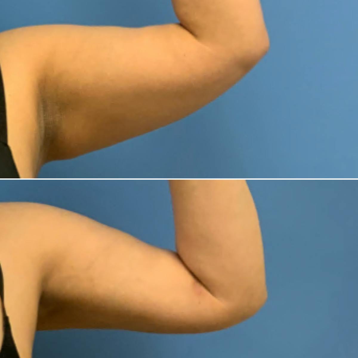 Liposuction Before & After Gallery - Patient 143280 - Image 2