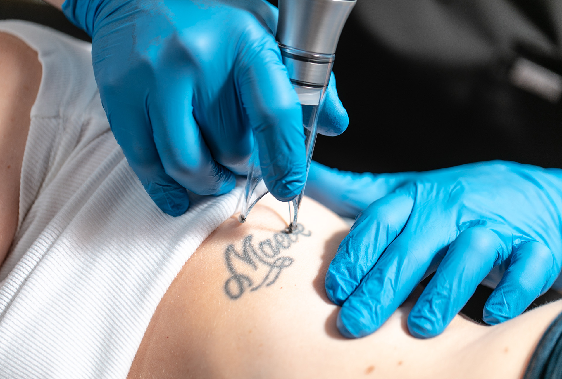 PicoSure Tattoo Removal in Hermitage, PA | Valeri L. Roth, DO