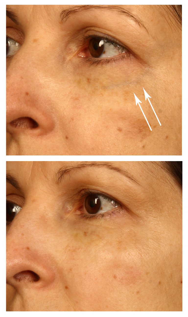 Laser Treatment for Blue Veins Around Your Eyes The Cosmetic Vein