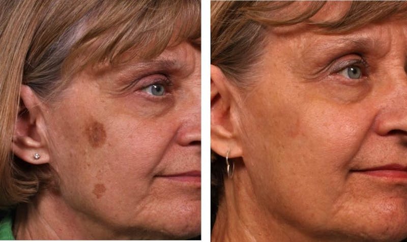 mole removal results