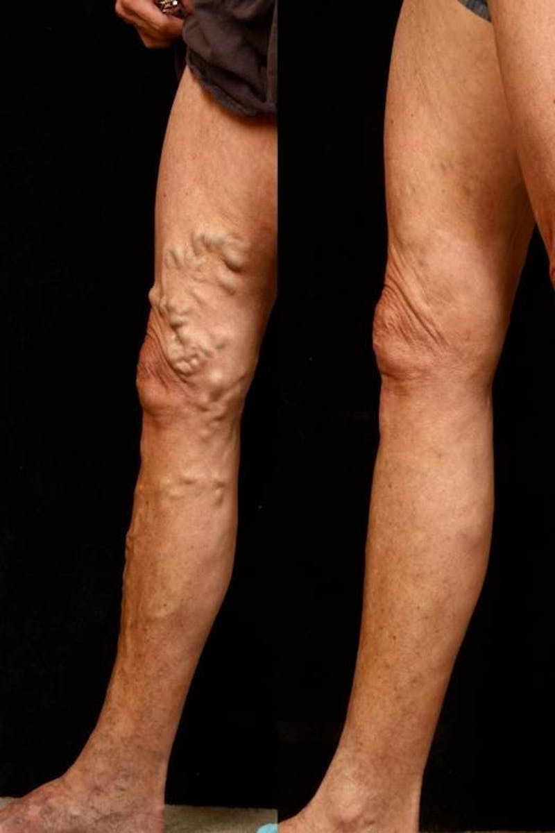 varicose vein treatment results