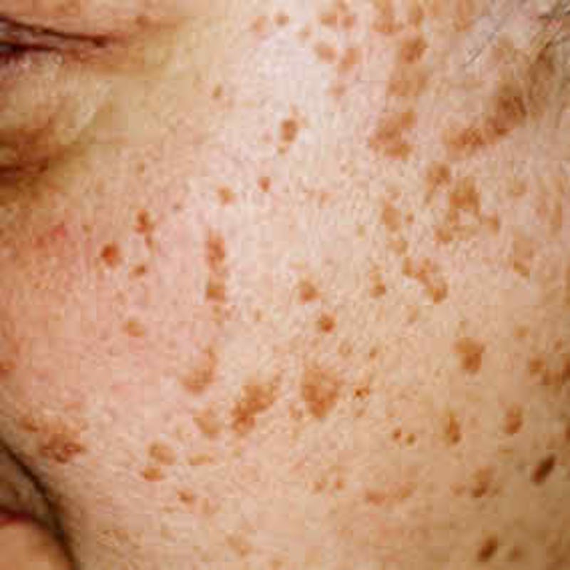 brown spots on face