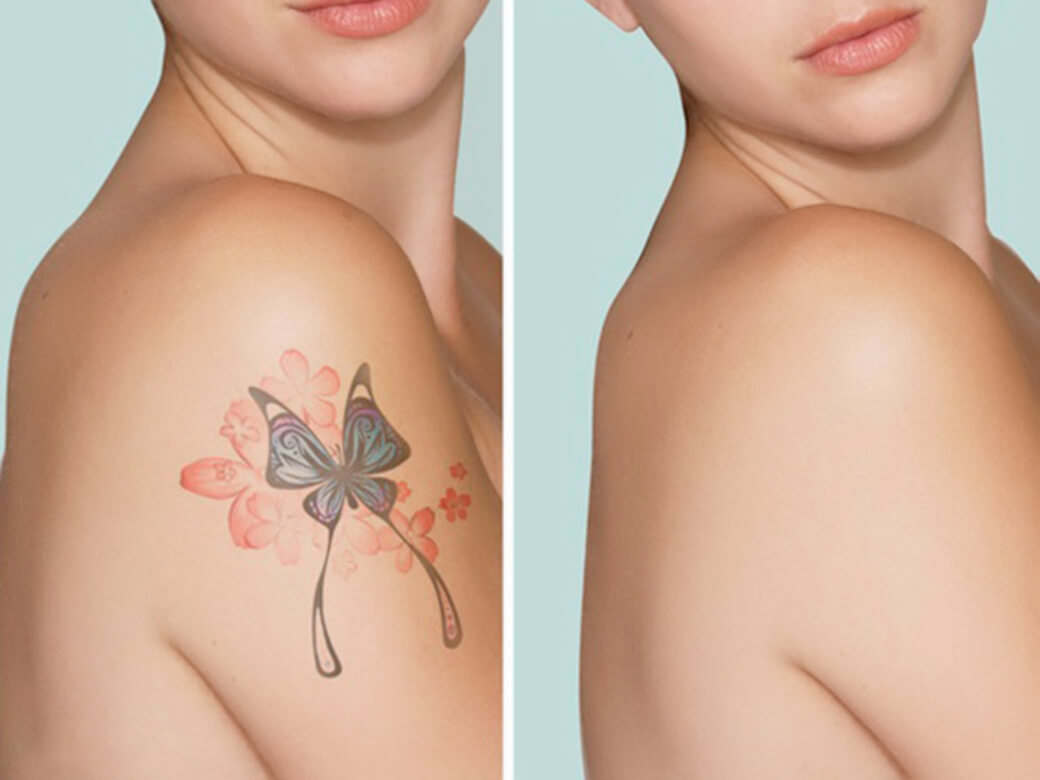What to Expect After Laser Tattoo Removal - The Aesthetics Centre