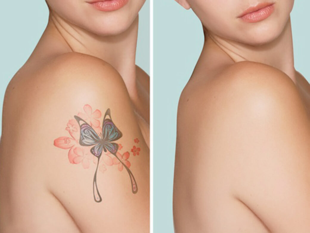 5 natural tattoo removal remedies you can try at home  Pulse Ghana