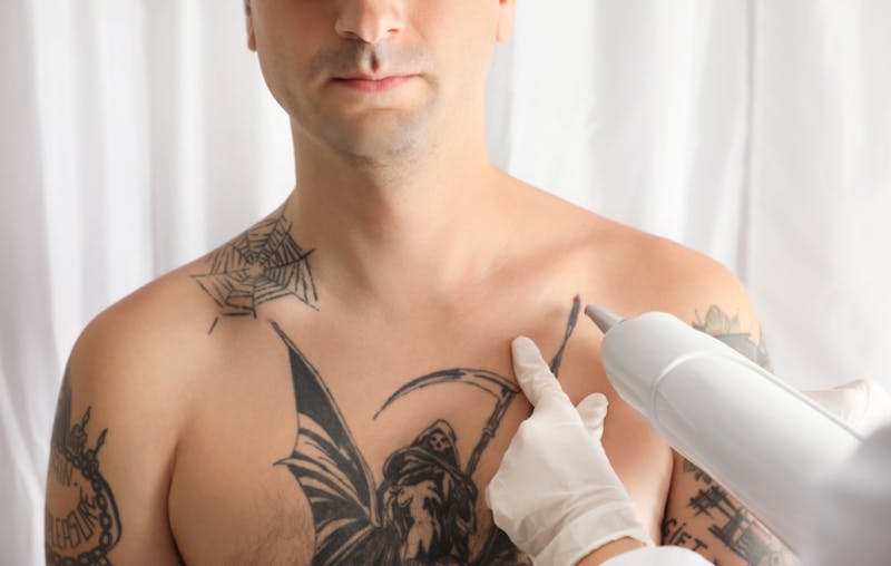 Man undergoing laser tattoo removal