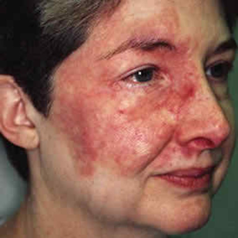 Birthmark and Hemangiomas Laser Treatments Before & After Gallery - Patient 37499362 - Image 2