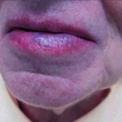 Birthmark and Hemangiomas Laser Treatments Before & After Gallery - Patient 37499371 - Image 2