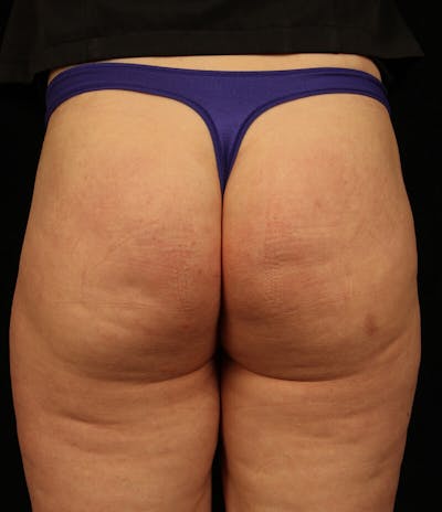 Cellfina® Before & After Gallery - Patient 37499392 - Image 1
