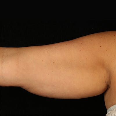 CoolSculpting Before & After Gallery - Patient 37499396 - Image 1