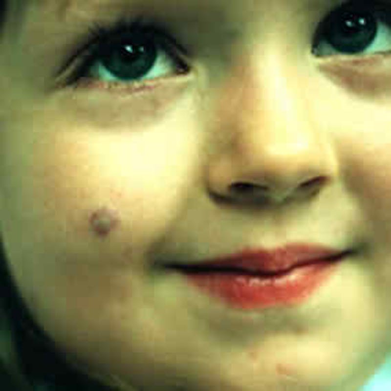 Birthmark and Hemangiomas Laser Treatments Before & After Gallery - Patient 37499394 - Image 1