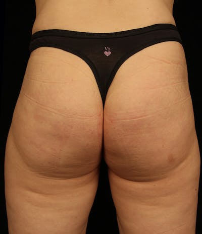 Cellfina® Before & After Gallery - Patient 37499392 - Image 2