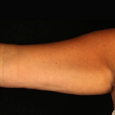 CoolSculpting Before & After Gallery - Patient 37499396 - Image 2