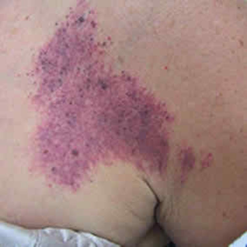 Birthmark and Hemangiomas Laser Treatments Before & After Gallery - Patient 37499408 - Image 1