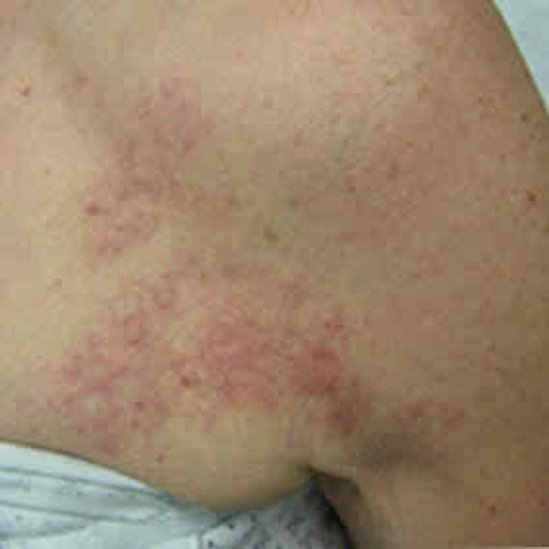 Birthmark and Hemangiomas Laser Treatments Before & After Gallery - Patient 37499408 - Image 2