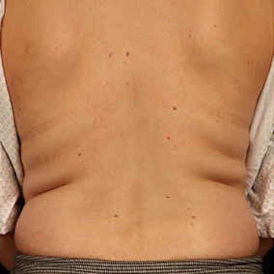 CoolSculpting Before & After Gallery - Patient 37499415 - Image 1