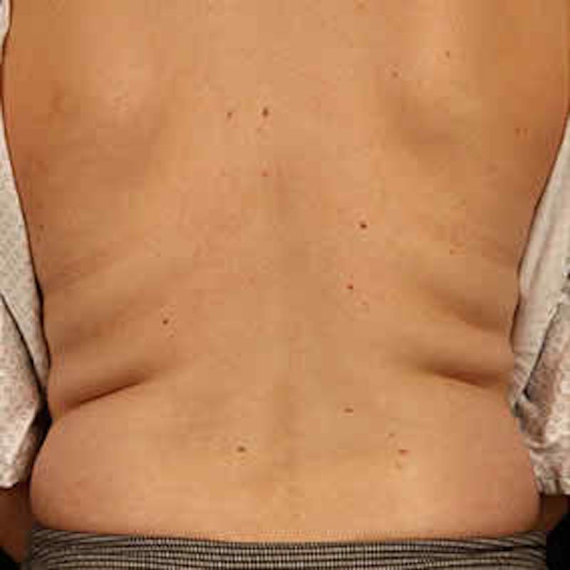 CoolSculpting Before & After Gallery - Patient 37499415 - Image 1