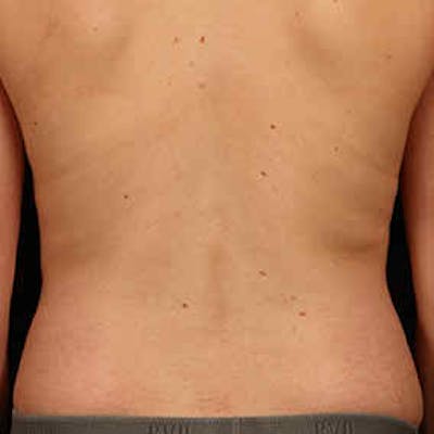 CoolSculpting Before & After Gallery - Patient 37499415 - Image 2