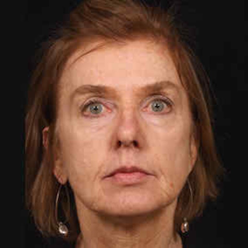 Cosmetic Filler Augmentation Before & After Gallery - Patient 37499418 - Image 1