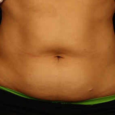 CoolSculpting Before & After Gallery - Patient 37499423 - Image 1