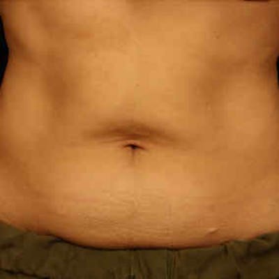CoolSculpting Before & After Gallery - Patient 37499423 - Image 2