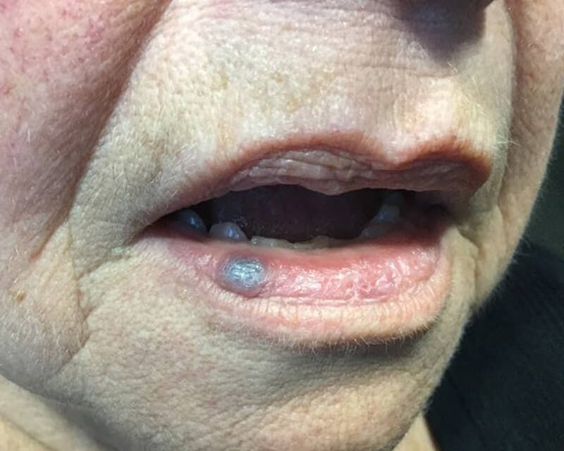 Facial Veins/Vascular Lesions Before & After Gallery - Patient 37499432 - Image 1