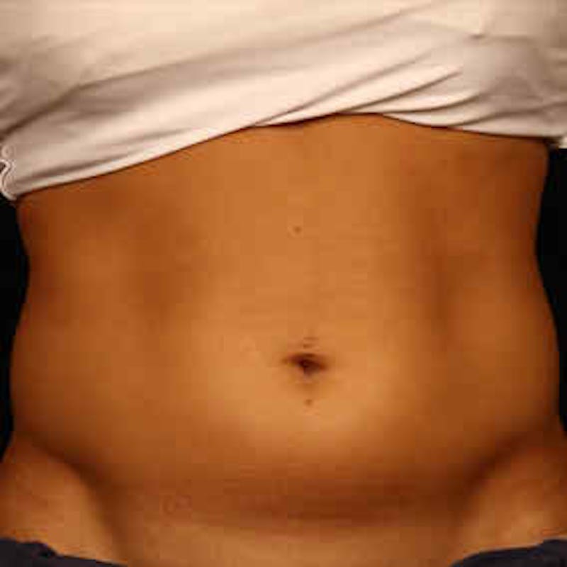 CoolSculpting Before & After Gallery - Patient 37499431 - Image 1