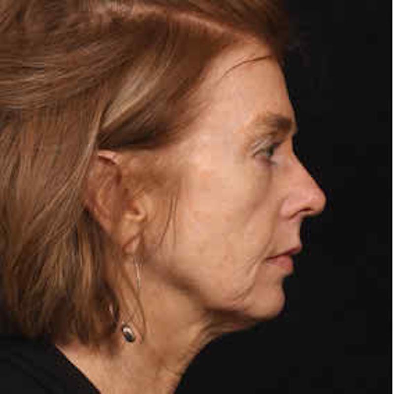 Cosmetic Filler Augmentation Before & After Gallery - Patient 37499434 - Image 1