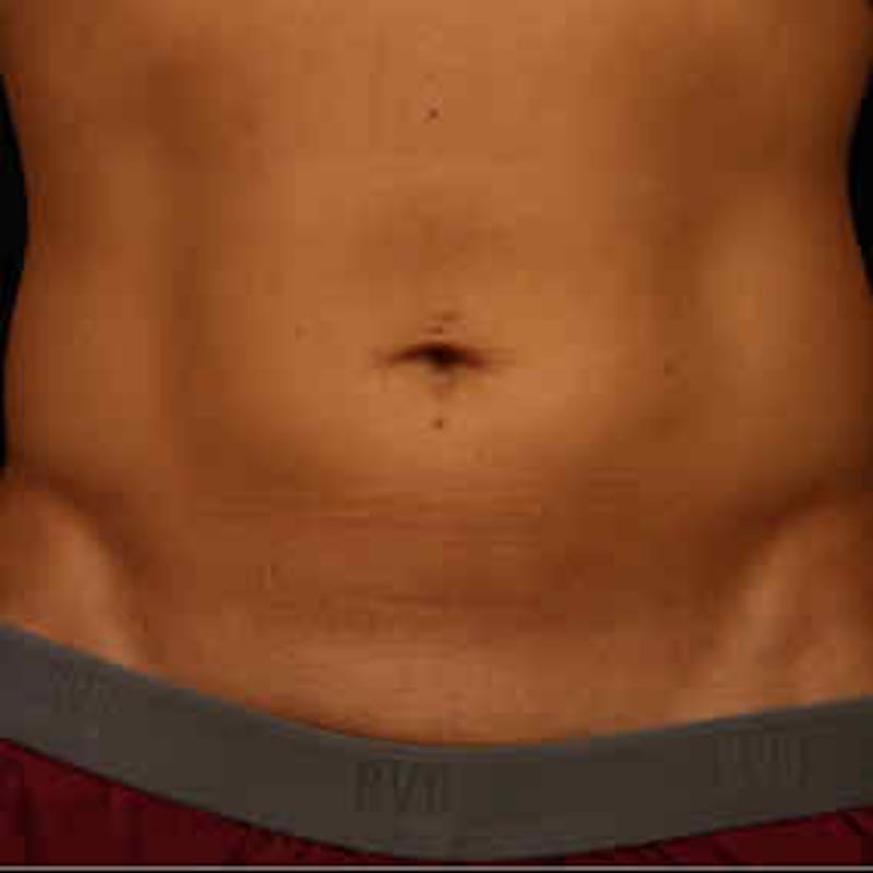 CoolSculpting Before & After Gallery - Patient 37499431 - Image 2
