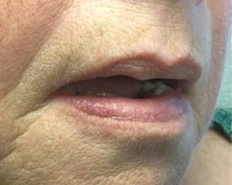 Facial Veins/Vascular Lesions Before & After Gallery - Patient 37499432 - Image 2