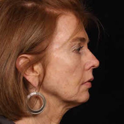 Cosmetic Filler Augmentation Before & After Gallery - Patient 37499434 - Image 2